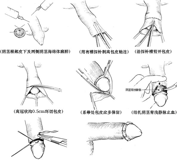 包皮手术最新技术，现代医疗进步与革新的探索