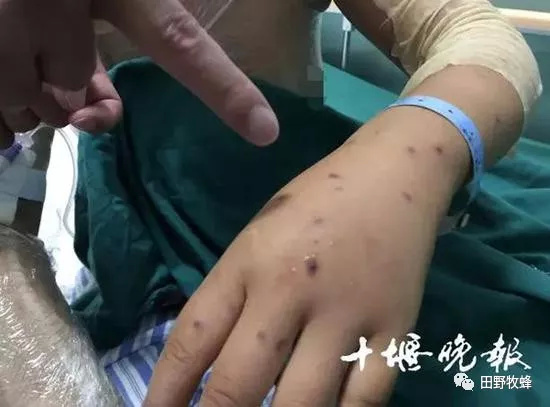 白小姐一肖一码准确一肖_男子景区游玩被马蜂蜇伤后休克,迅速执行解答计划_Lite32.34.91