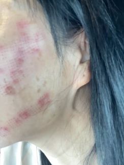 女生美容院拔罐后变紫薯精