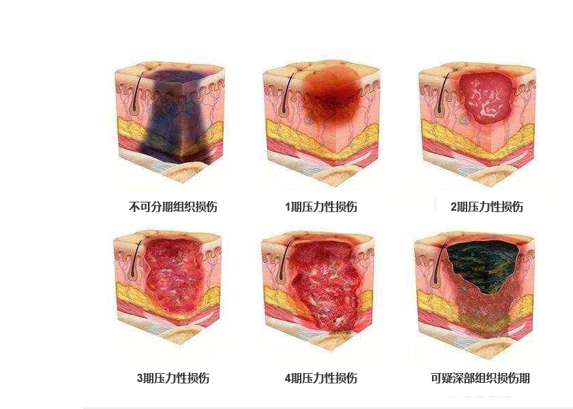 压疮分期与小明的康复之旅，爱的陪伴下的压疮奇遇