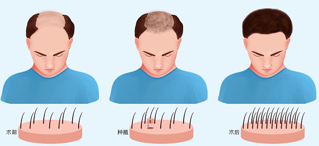 最新植发技术重塑自信与魅力，引领植发新时代